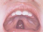Cleft Palate